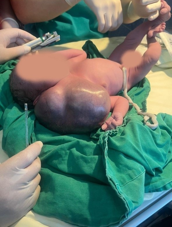 Read more about the article INTERVENȚIE DE EXCEPȚIE! Viața unui bebeluș a fost salvată, după ce o echipă medicală din Cluj i-a îndepărtat o tumoră de 800 de grame!