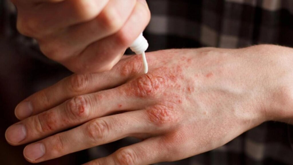 Read more about the article De unde a plecat infecția? Mama pacientelor cu lepră, diagnosticată în țara de baștină